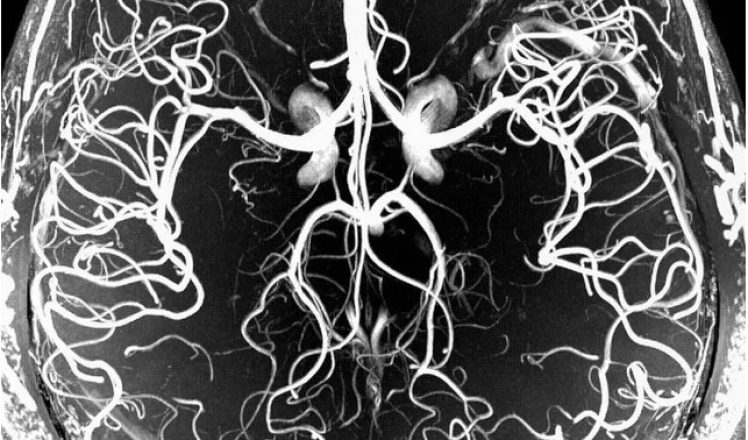 mra-brain